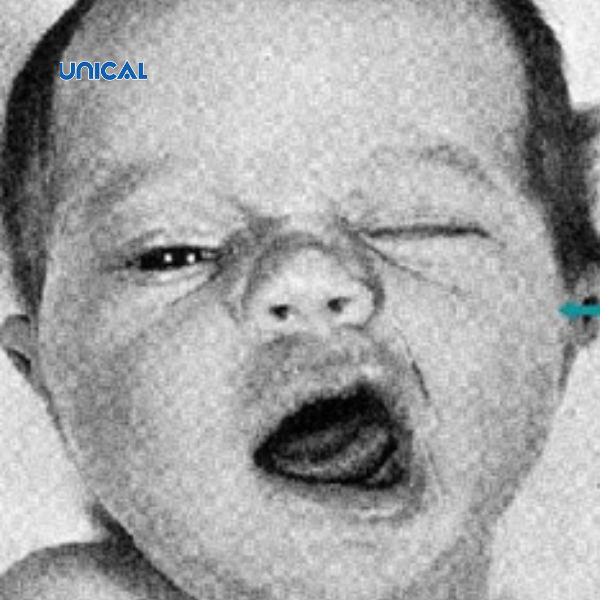 Dấu Dấu hiệu Chvostek cho thấy hạ canxi máu ở trẻ em