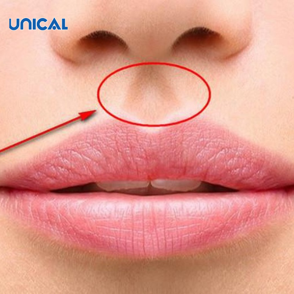 Bước 2: Nhấn huyệt nhân trung để giữ bệnh nhân tỉnh táo