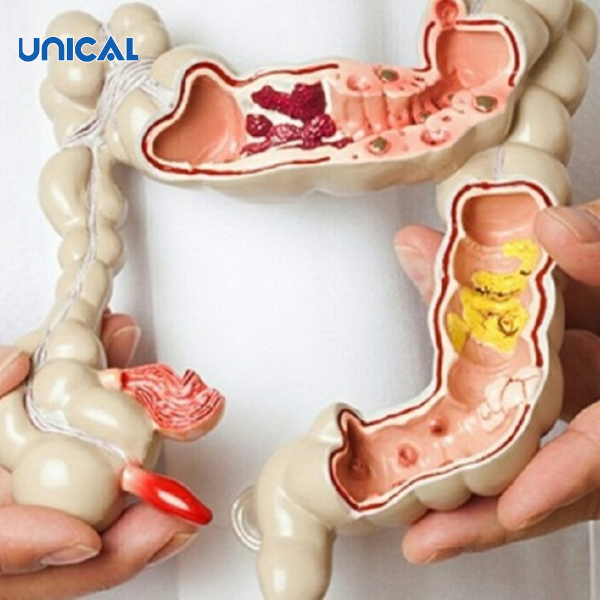 Một triệu chứng thiếu canxi ở phụ nữ sau sinh khác nữa là gặp các vấn đề về đại tràng