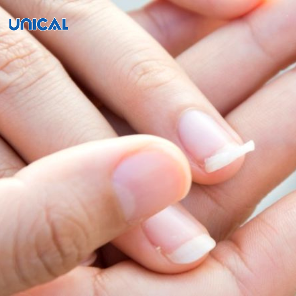 Móng tay phụ nữ sau sinh dễ gãy do thiếu canxi