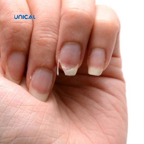 Móng tay dễ gãy là triệu chứng thiếu canxi