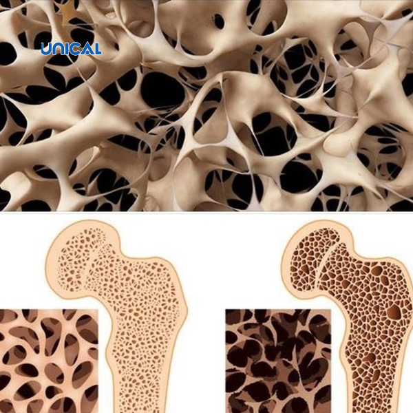 Loãng xương là hậu quả của thiếu canxi trong thời gian dài
