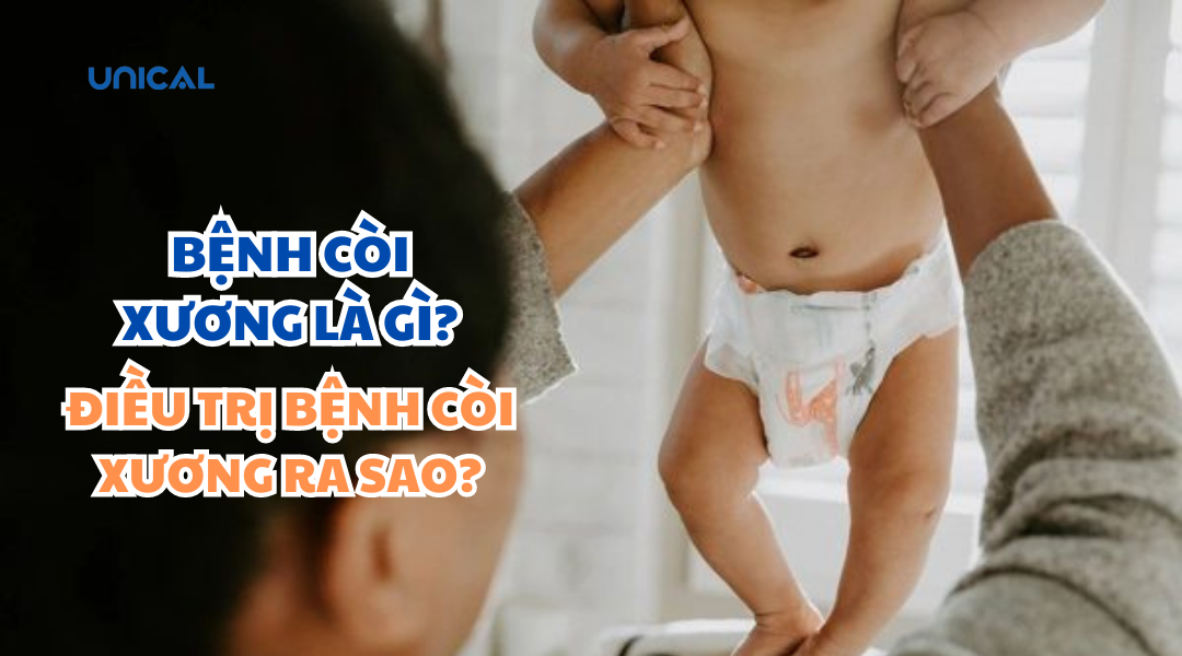 Bệnh còi xương là gì Điều trị bệnh còi xương ra sao